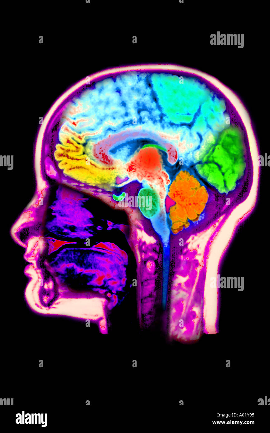 Irm du cerveau montrant l'anatomie normale Banque D'Images