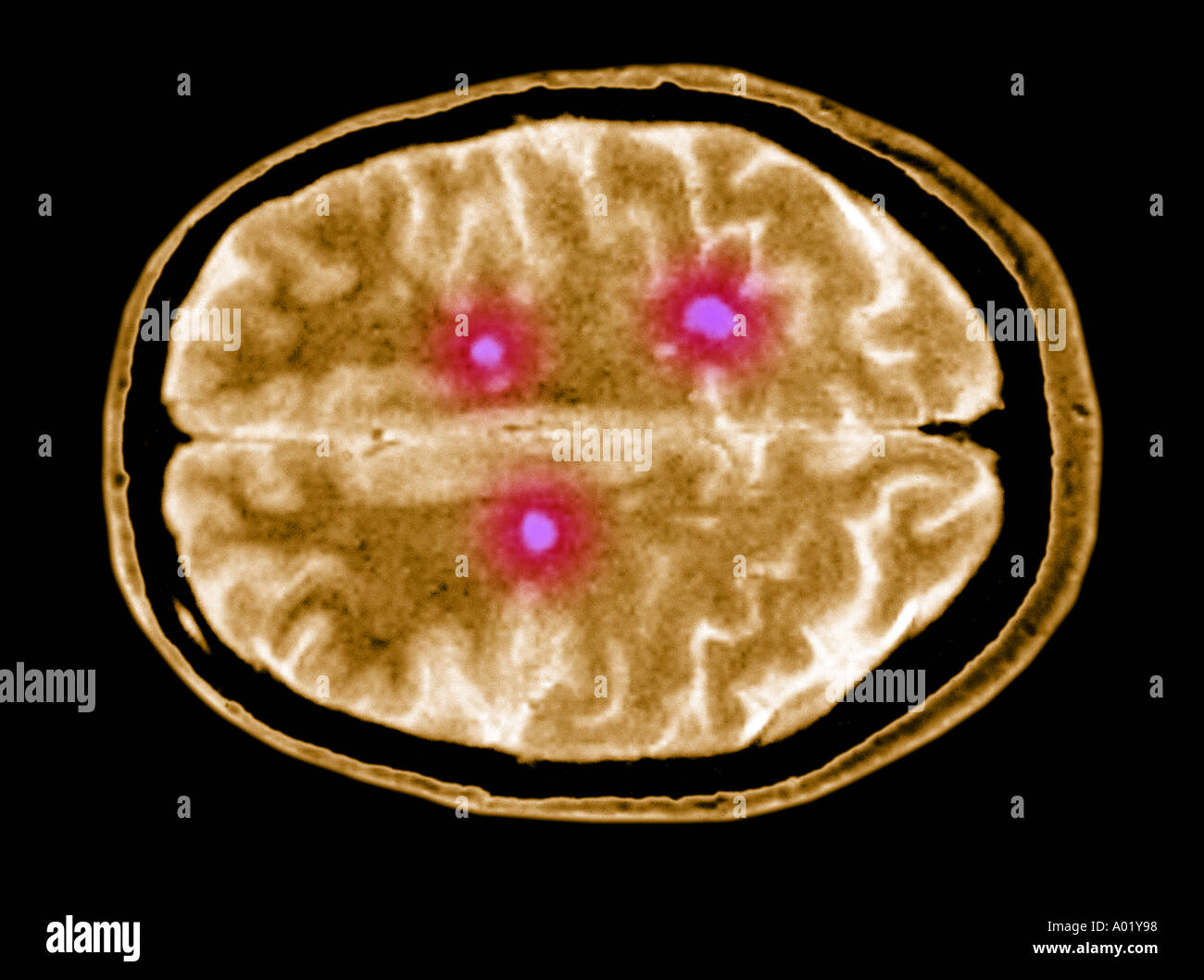 Irm du cerveau montrant les plaques de sclérose en plaques Photo Stock