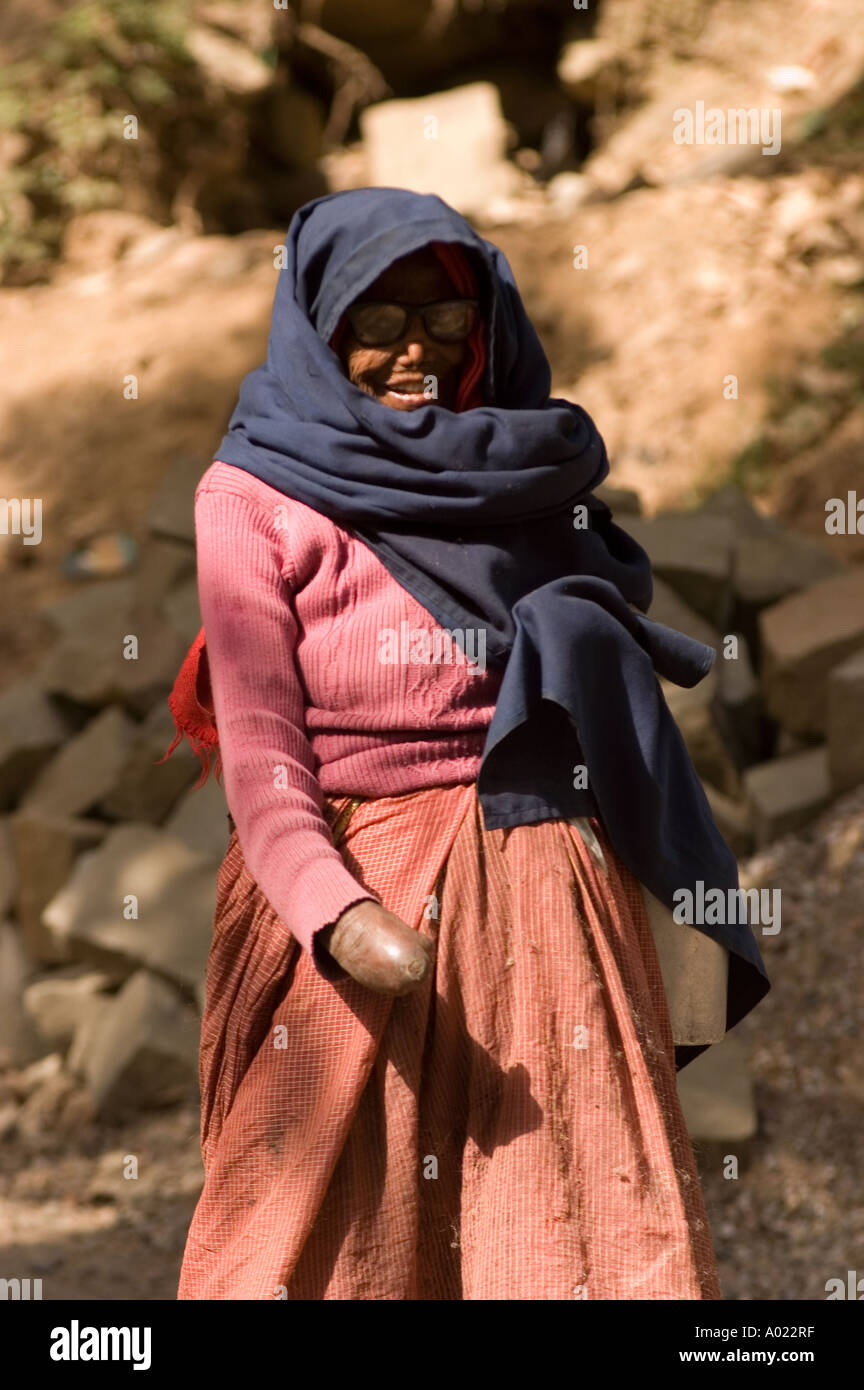 Femme indienne avec part détruit par la léprose Banque D'Images