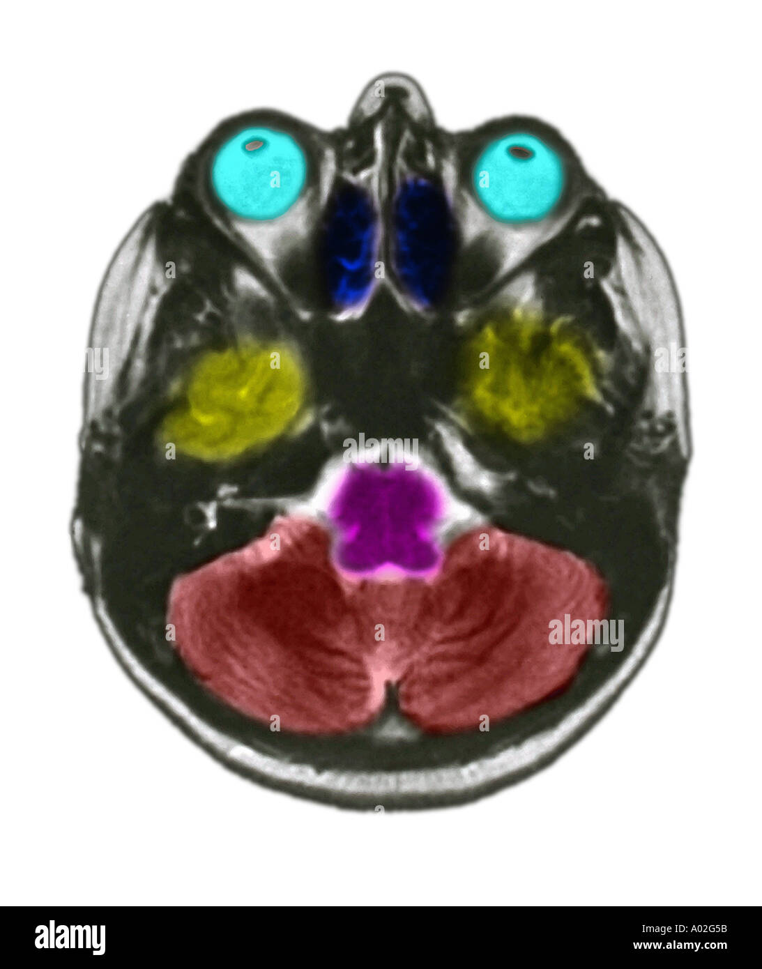 Scan IRM de cerveau d'une femme Banque D'Images