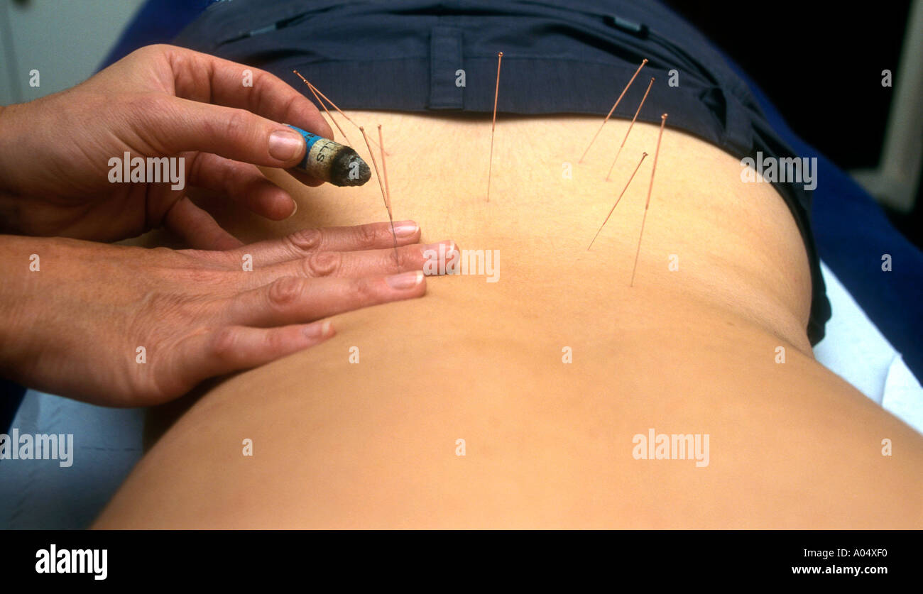 Les aiguilles d'Acupuncture étant chauffée en séance de traitement Photo  Stock - Alamy