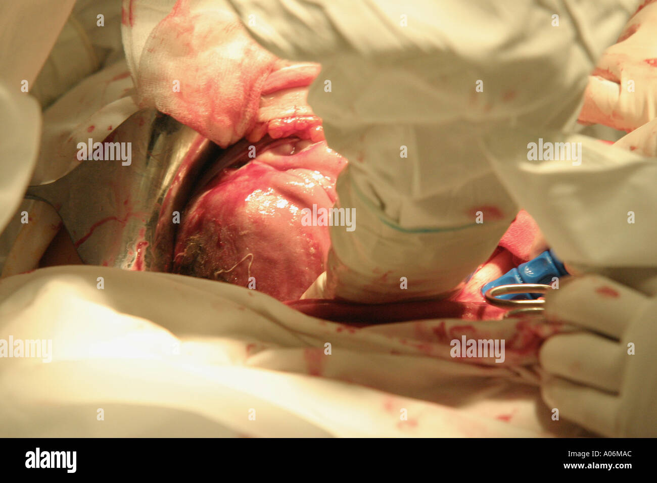 Close up de la tête au cours d'une nouvelle césarienne en théâtre au cours d'une naissance. Banque D'Images