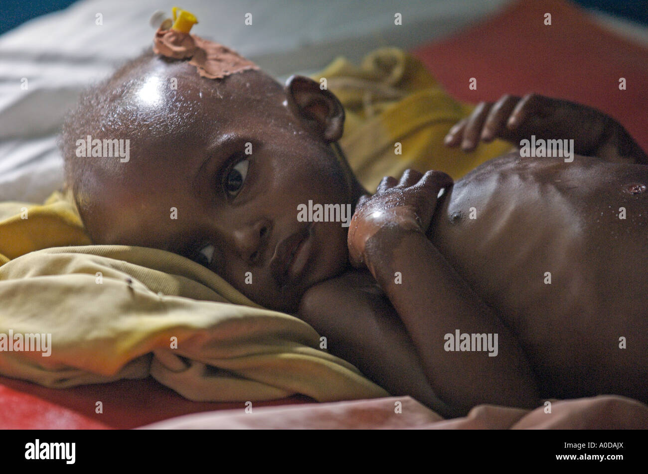 Un enfant souffrant de malnutrition grave dans l'hôpital central de Merca, Somalie. Banque D'Images Un enfant souffrant de malnutrition grave dans l'hôpital central de Merca, Somalie. Banque D'Images