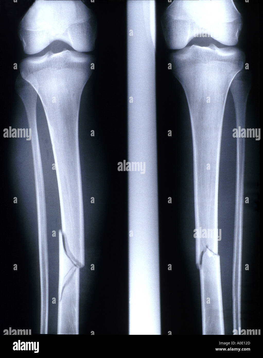 Tibia Fracture Banque d