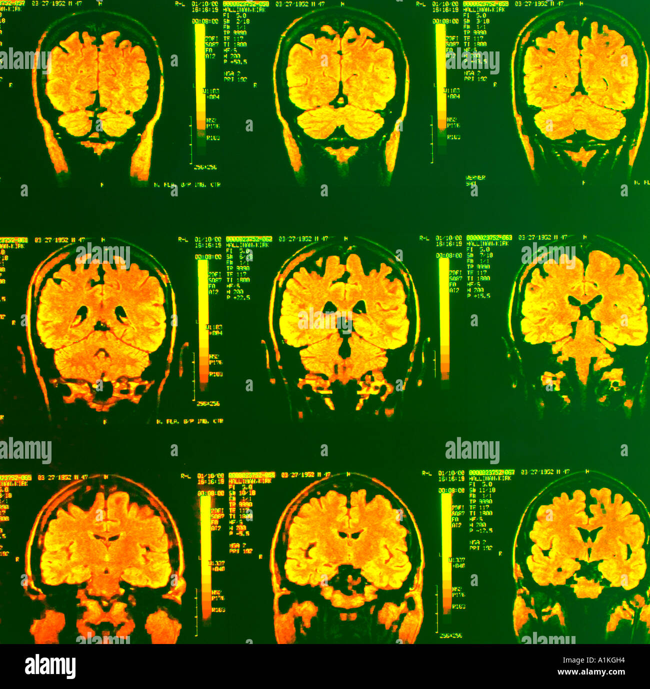 Les rayons colorés de cortex cérébral cervelet IRM du cerveau humain Banque D'Images