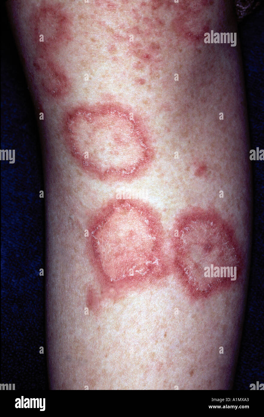 éruptions cutanées de lupus Photo Stock - Alamy
