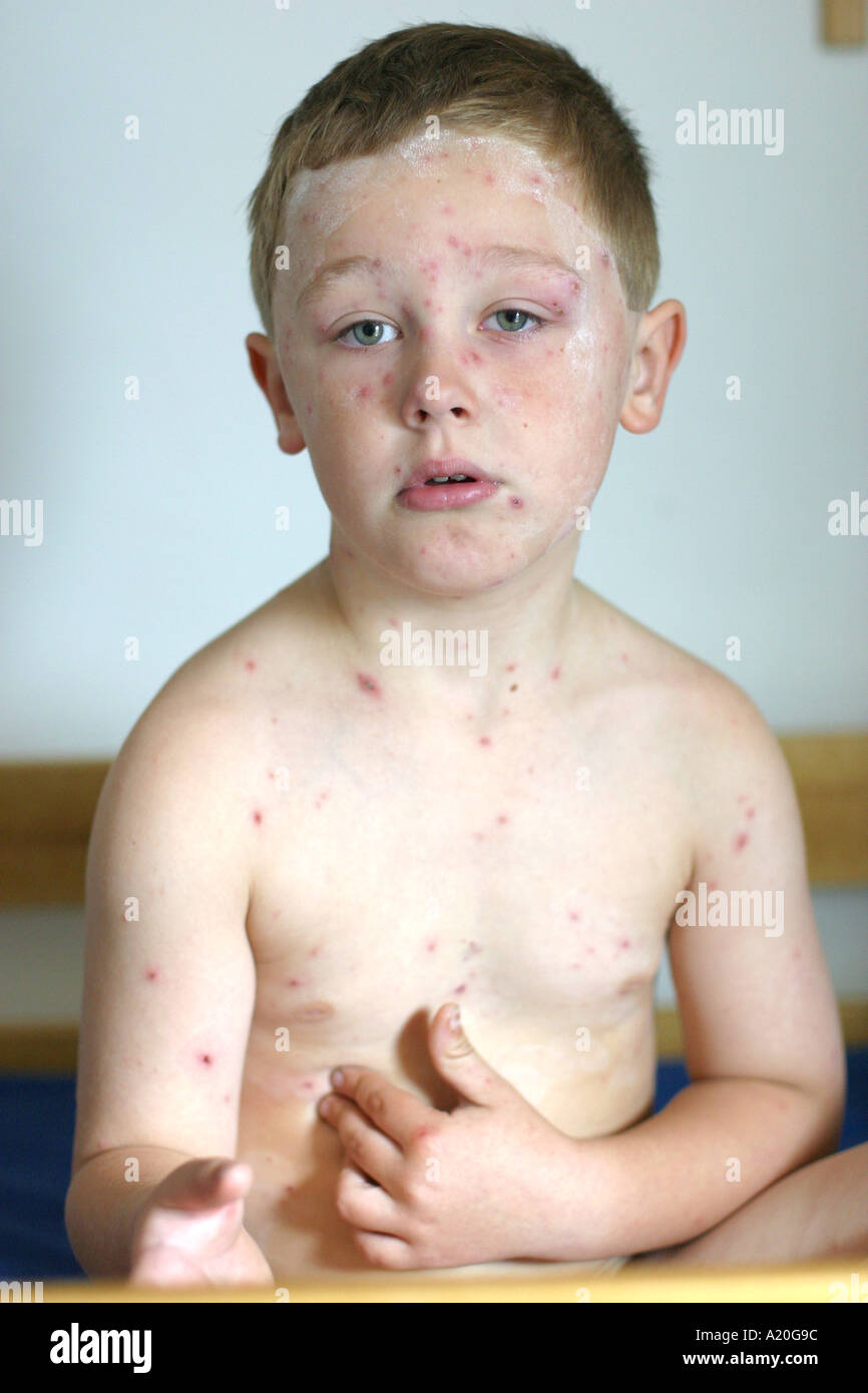 Un jeune garçon atteint les yeux rouges morts causés par le virus de la varicelle. Banque D'Images