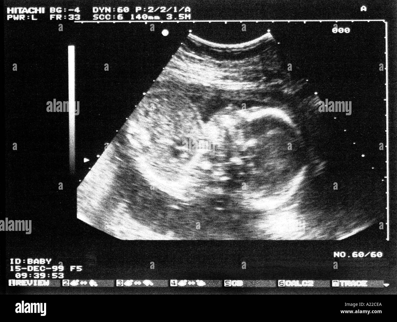 Échographie d'un fœtus âgé de 20 semaines Banque D'Images