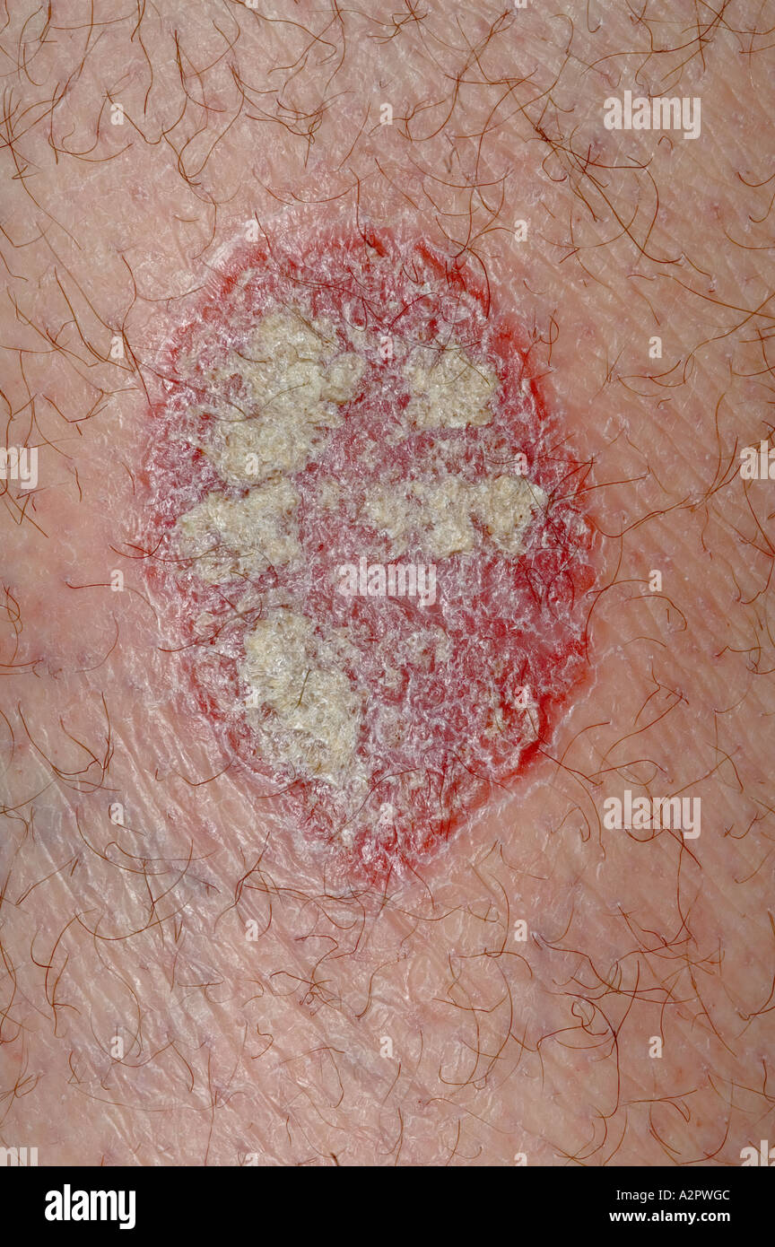 Psoriasis en plaques Banque de photographies et d’images à haute
