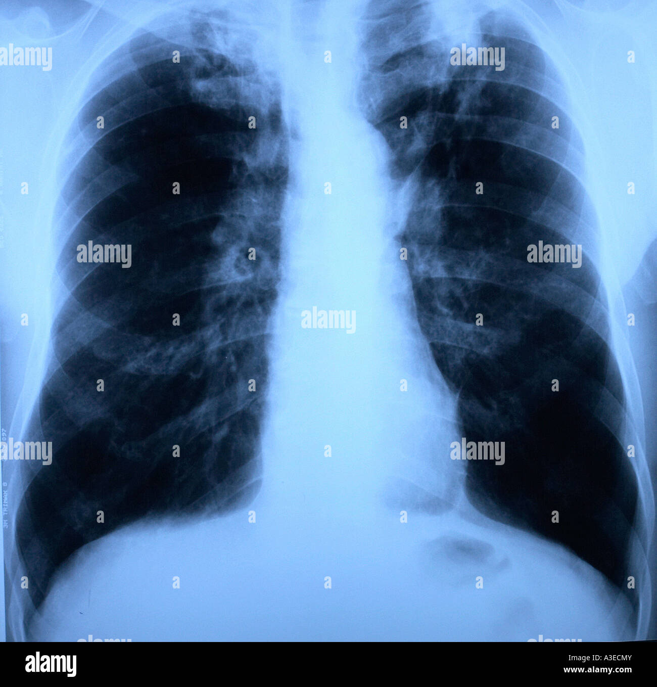 X-ray des poumons et du thorax avec lobes supérieurs - des deux côtés de la tuberculose Banque D'Images
