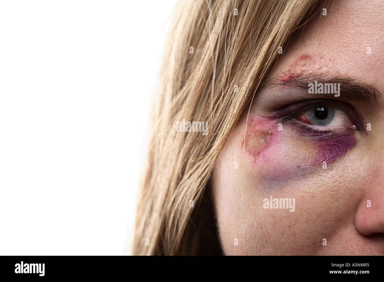 Femme avec oeil noir Banque D'Images