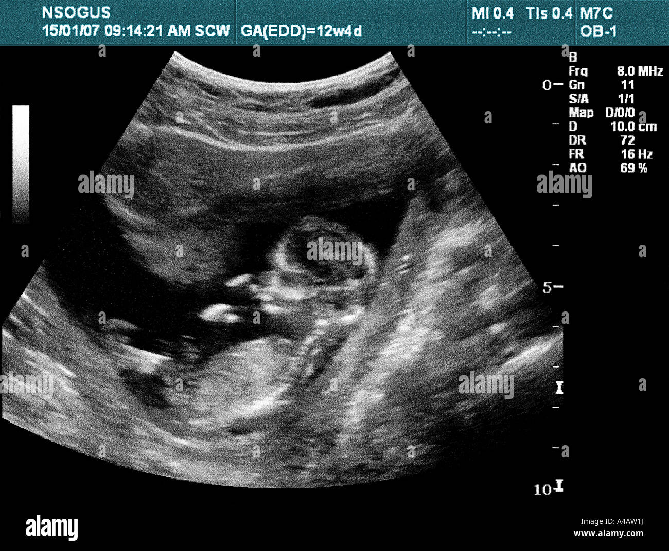 L Image Echographique D Un Bebe Dans L Uterus Sucant Son Pouce De L Autre Main Derriere Sa Tete Une Image Classique Photo Stock Alamy L Image Echographique D Un Bebe Dans L Uterus Sucant Son Pouce De L Autre Main Derriere Sa Tete Une Image Classique Photo Stock Alamy