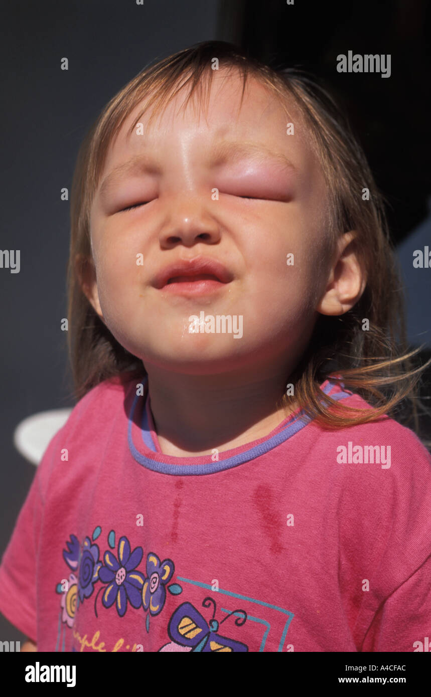 Fille De Trois Ans Avec Le Front Et Les Yeux Gonfles Ferme Contre Les Piqures De Moustiques Photo Stock Alamy