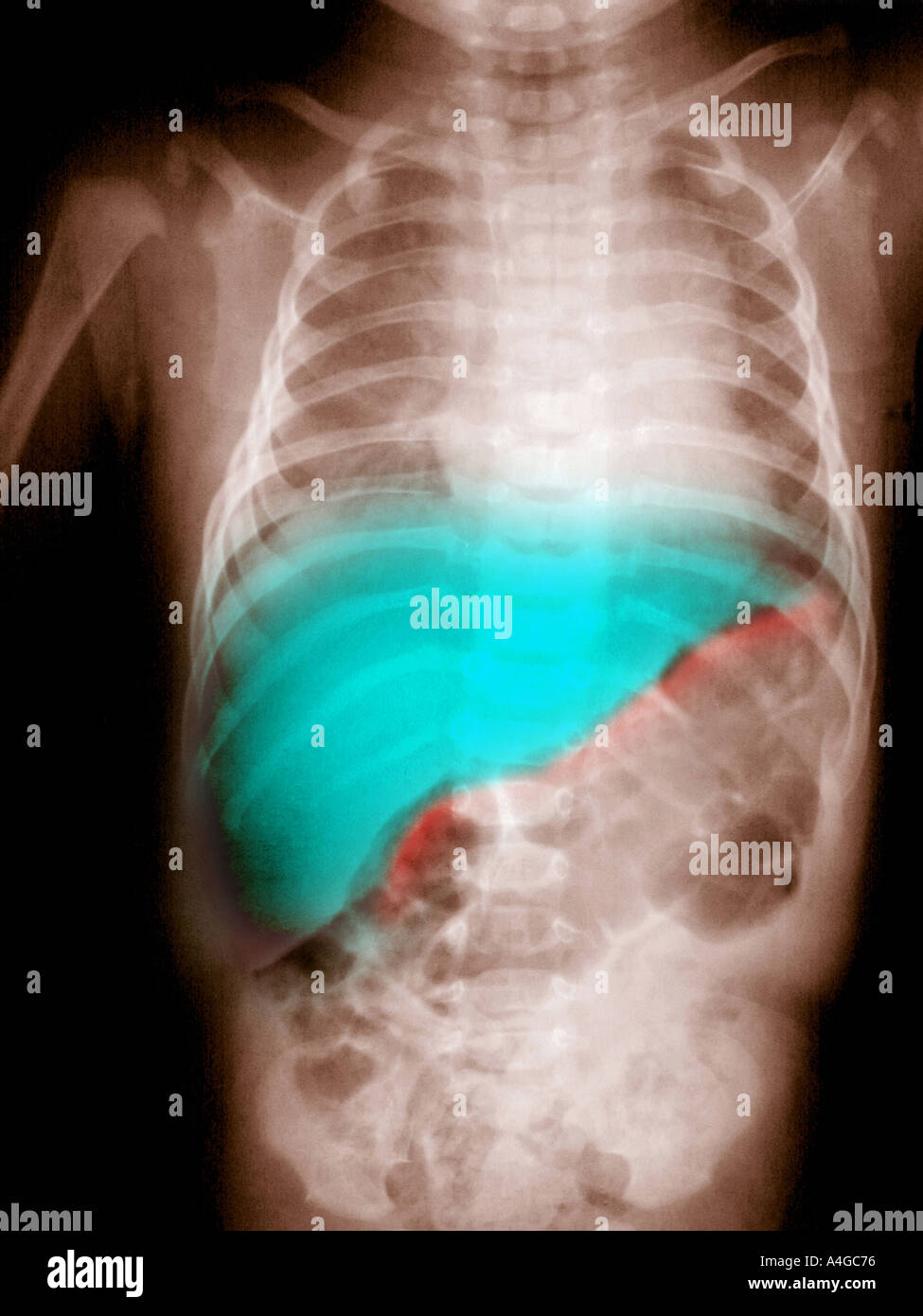 Garçon de 3 mois abdomen xray soulignant le foie normal indiqué en vert Banque D'Images