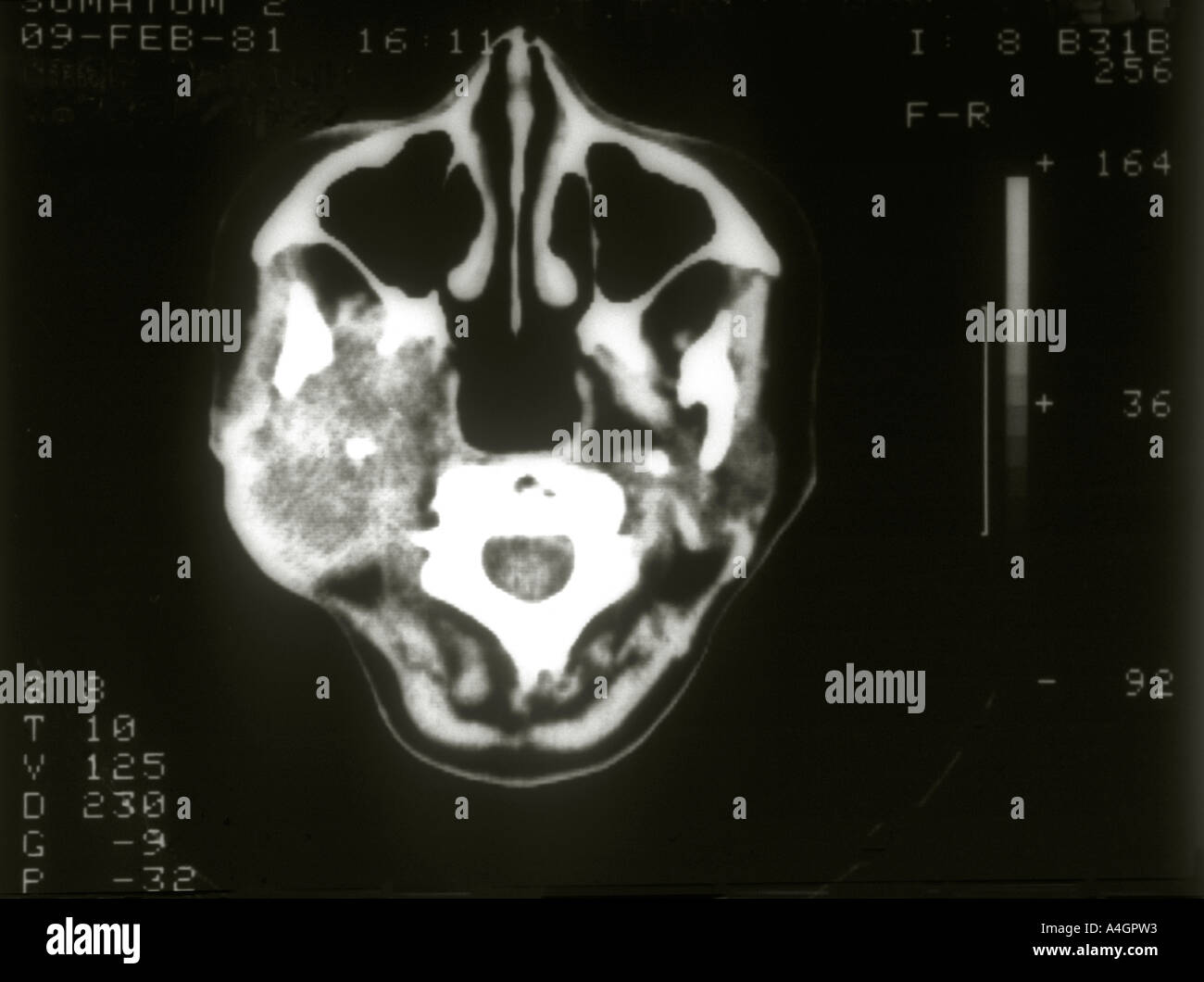 Un scanner montrant une grande tumeur de la glande parotide. Banque D'Images