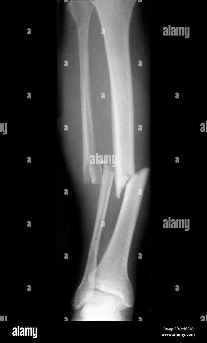 Une radiographie montrant une fracture du tibia et du péroné de la jambe. Banque D'Images