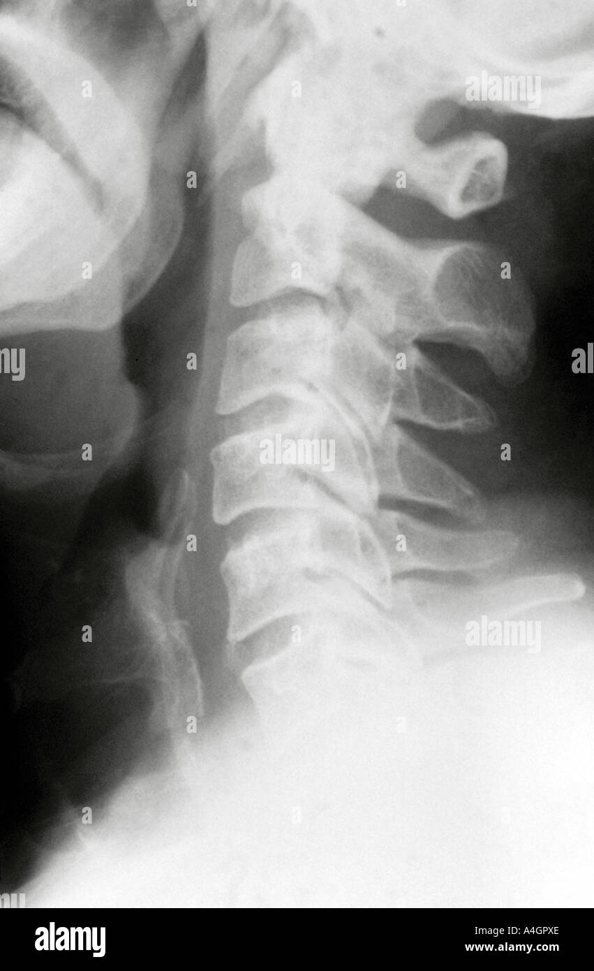 C'est une radiographie de la colonne cervicale normale Photo Stock - Alamy