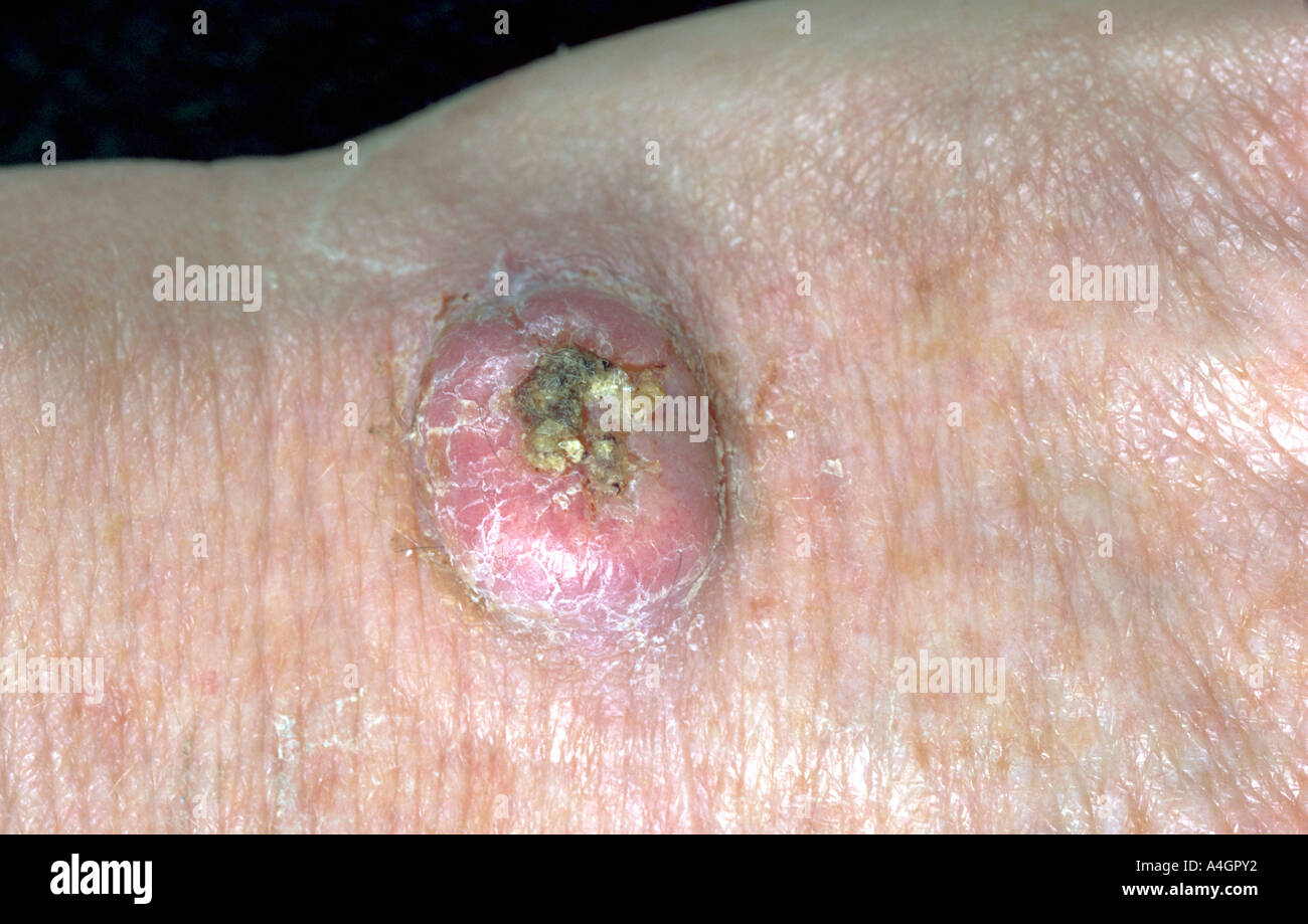Une photographie d'un carcinome squamous de cellules (SCC), le deuxième plus fréquent après le cancer de la peau le carcinome baso-cellulaire Banque D'Images