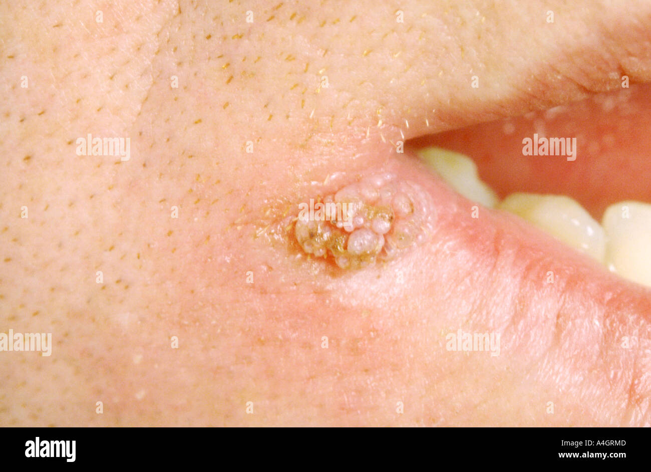Les verrues cutanées, ou verrucae vulgaris, apparaissent généralement sur la peau kératinisée, vraisemblablement au site d'inoculation Banque D'Images