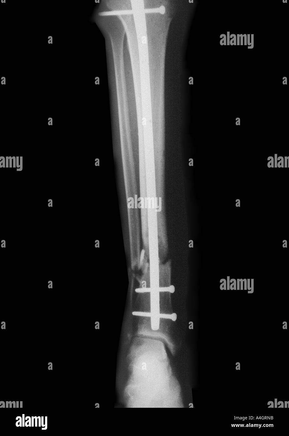 Une radiographie d'un clou intramédullaire pour une fracture du tibia. Banque D'Images