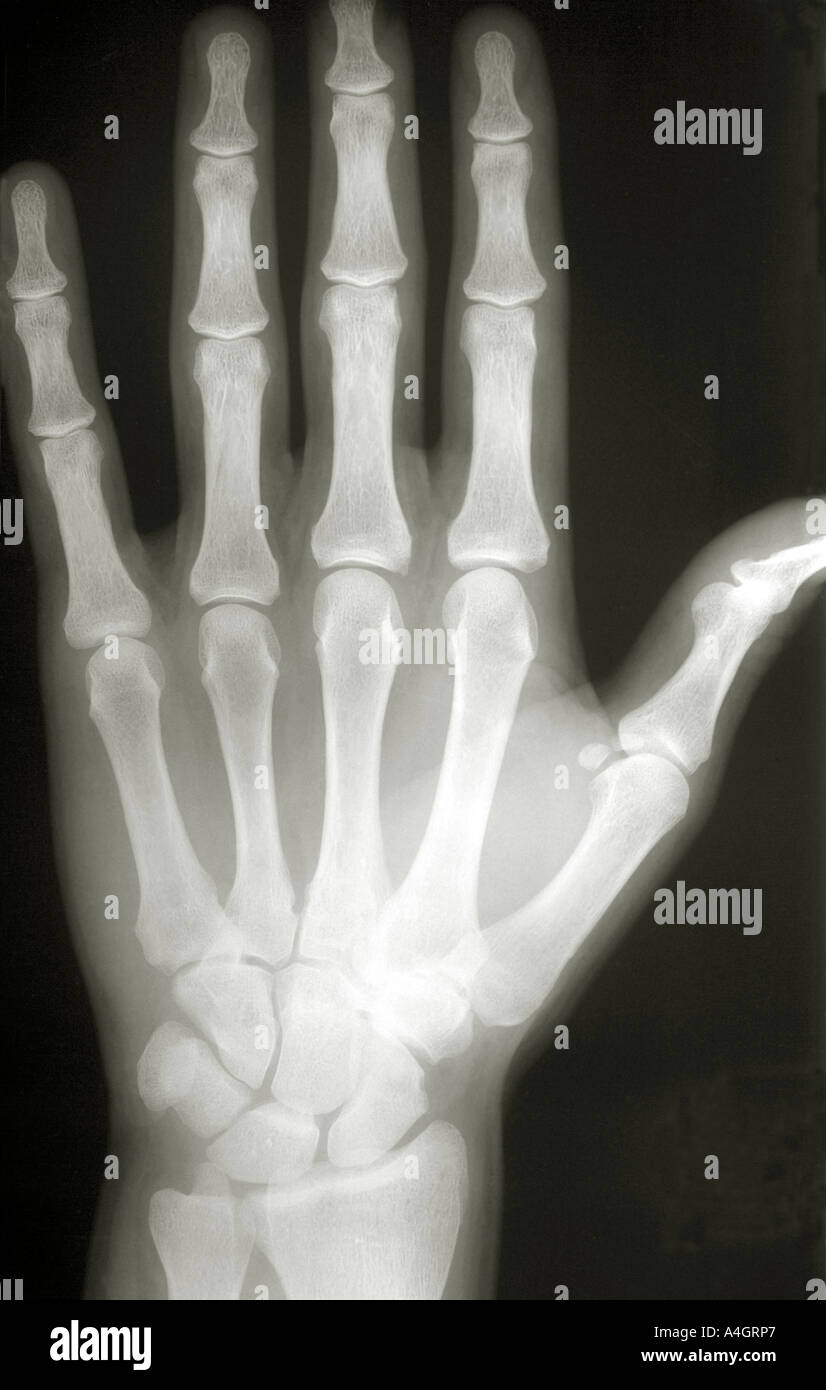 C'est une radiographie d'une main normale montrant les phalanges, les métacarpes et les carpals Banque D'Images