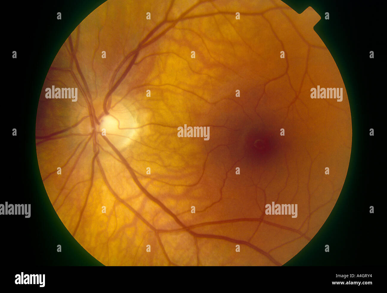 Une photographie d'une rétine normale. Une vue d'une rétine normale de l'œil gauche, montrant le disque optique et la région maculaire. Banque D'Images