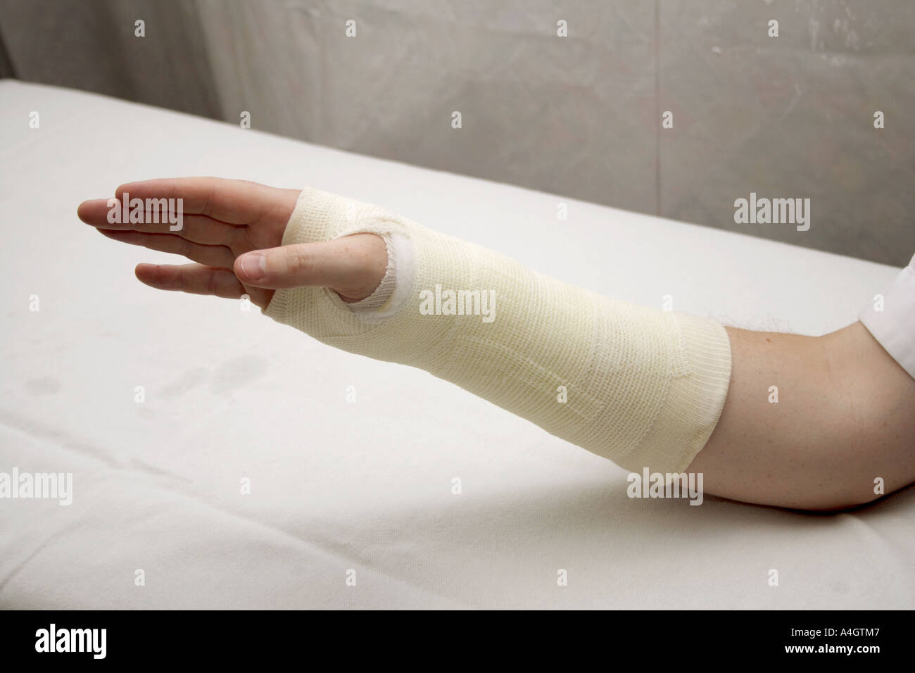 Une photographie d'un coude léger ci-dessous plâtre en fibre de verre pour l'immobilisation des fractures du poignet. Banque D'Images
