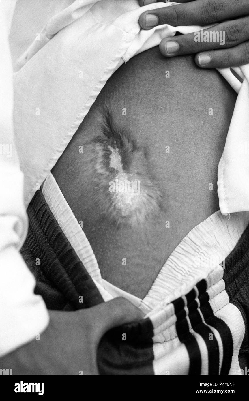 Blessure de guerre à l'arabe mans hanche, Kirkouk Banque D'Images