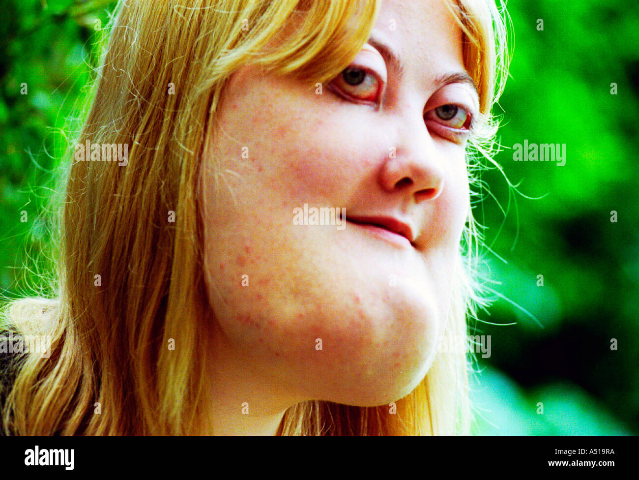 Une jeune femme avec chérubisme. La maladie génétique rare est une