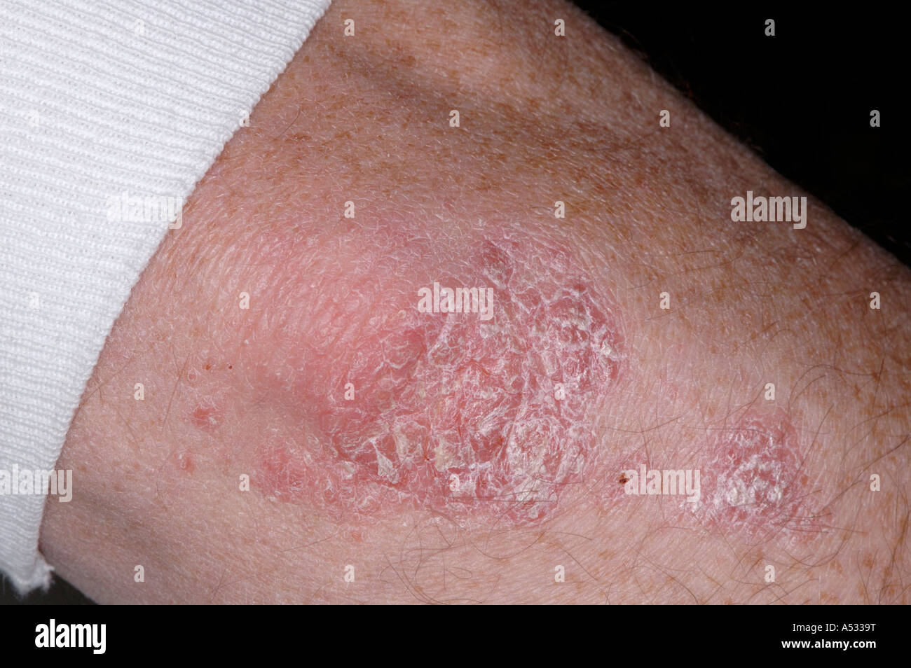 Le psoriasis en plaques close-up sur le coude Photo Stock - Alamy
