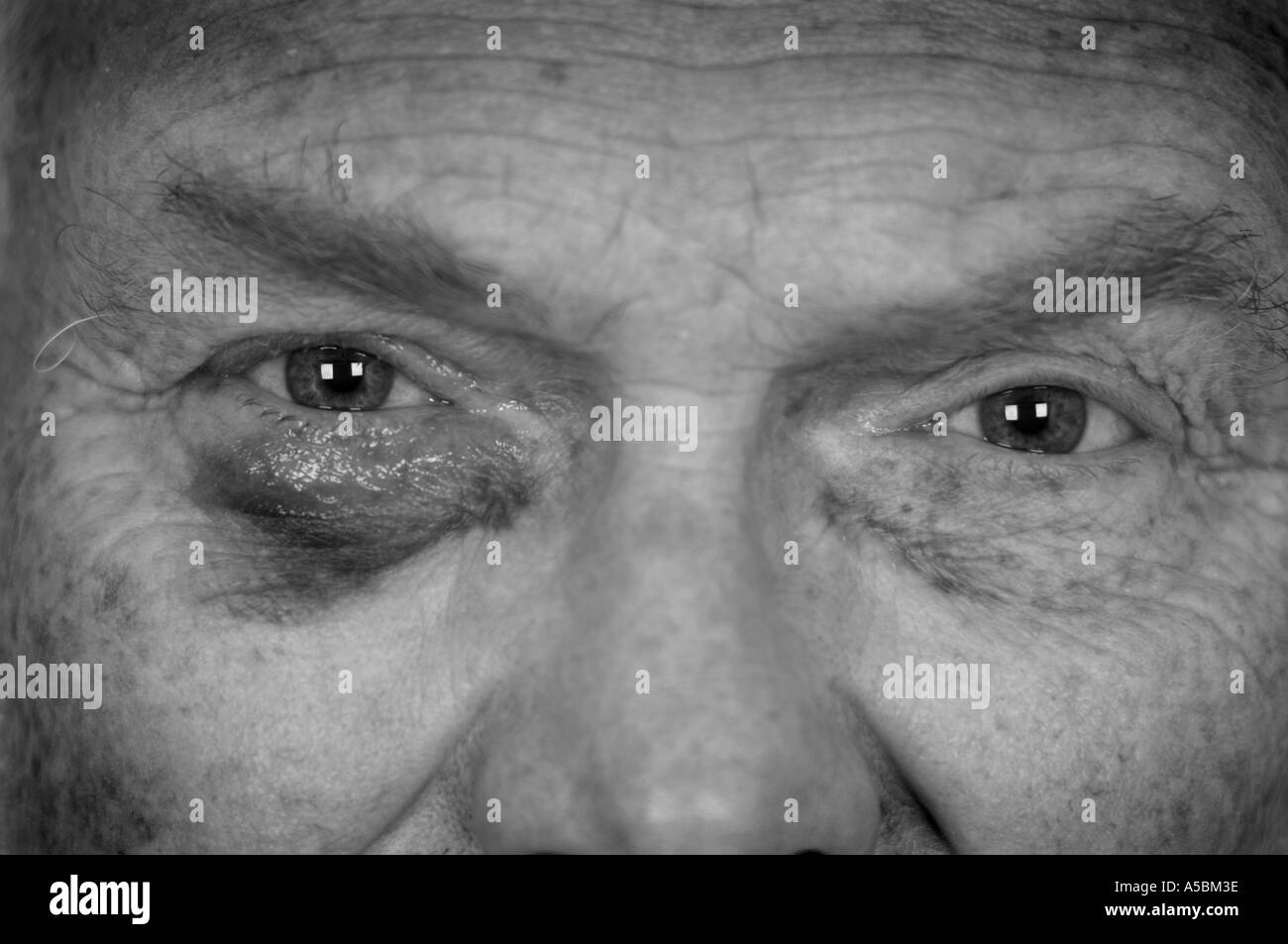 Un homme avec un oeil noir et meurtri après une lutte monochrome noir blanc Banque D'Images