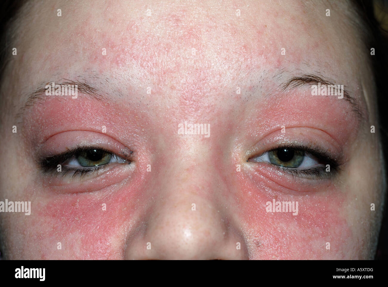 Irritation de la peau de la dermatite de contact sur le visage d'une jeune  fille de 16 ans Photo Stock - Alamy