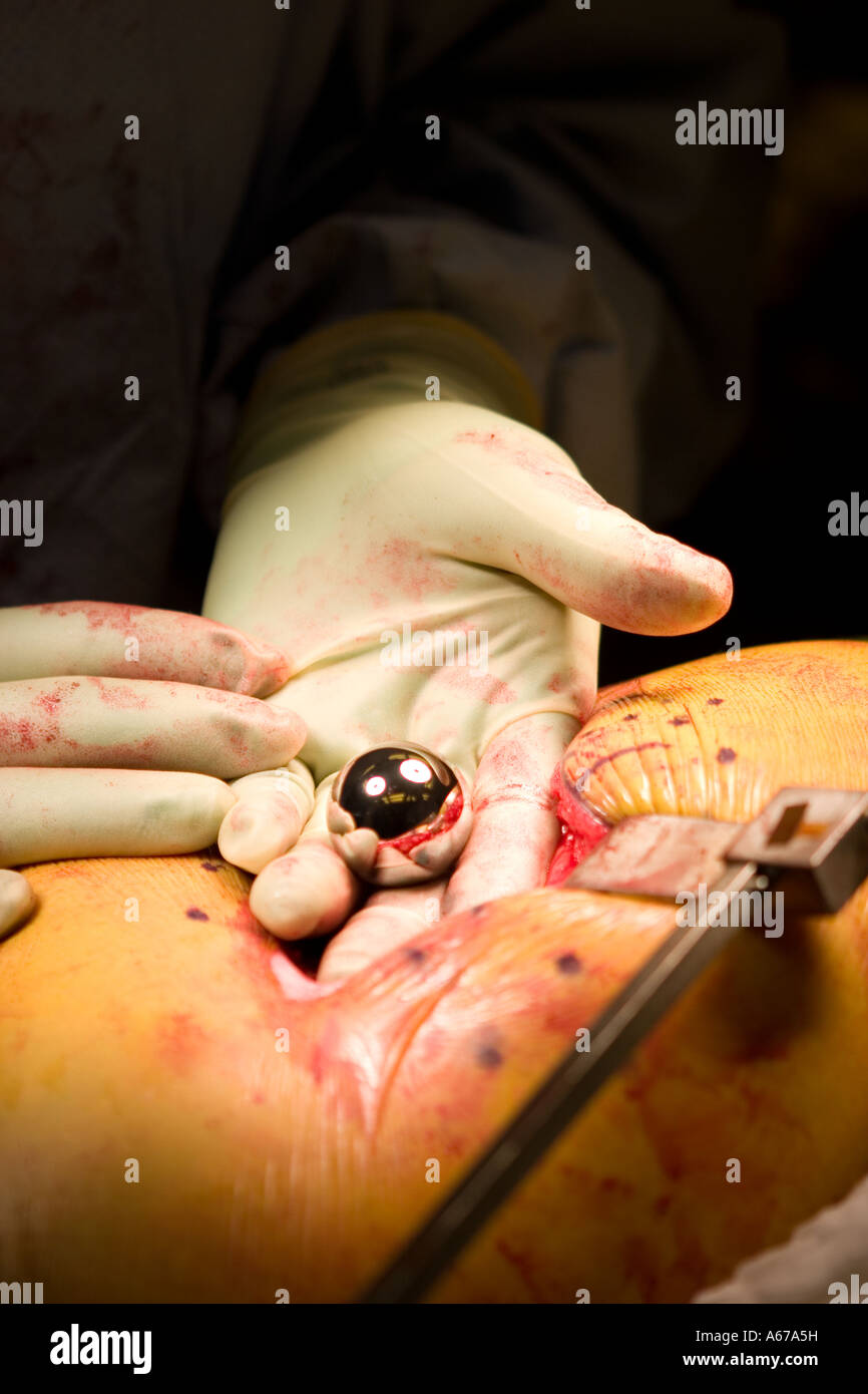 Remplacement chirurgien est titulaire d'une tête fémorale artificielles faites de plus de chrome-cobalt sur un site d'incision de la hanche Banque D'Images