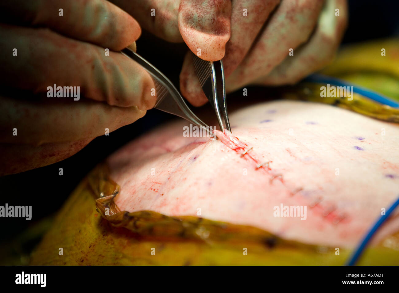 Chirurgien de la fermeture ou de la fusion d'une incision après chirurgie de remplacement de la hanche Banque D'Images
