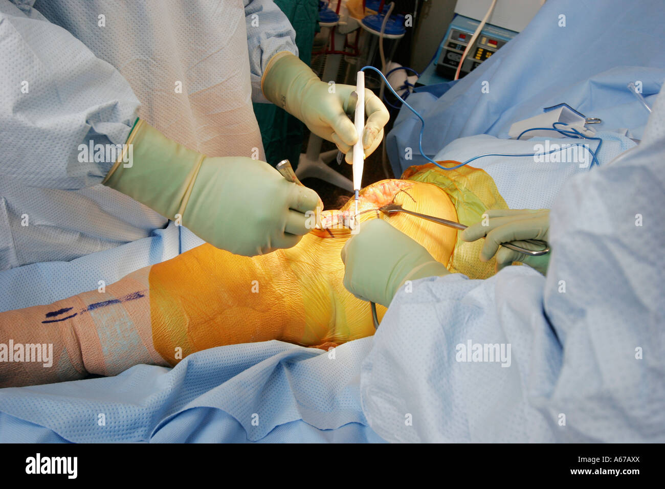 Chirurgien disséquant les tissus mous autour du genou pour avoir accès à l'aide d'un bistouri électrique ou bovie Banque D'Images
