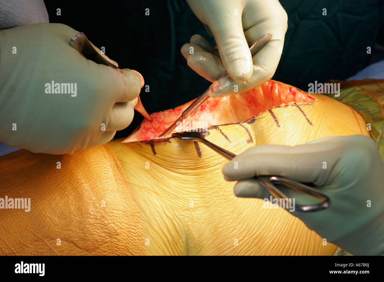 Mains rend chirurgien bistouri dans l'articulation du genou en préparation pour le remplacement prothétique Banque D'Images