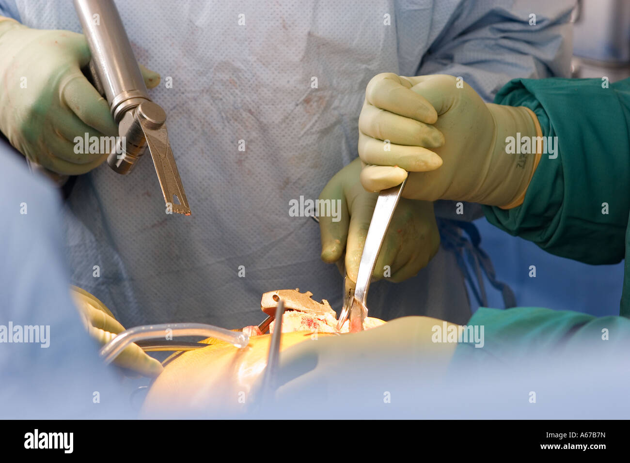 La chirurgie de remplacement de la hanche Banque D'Images