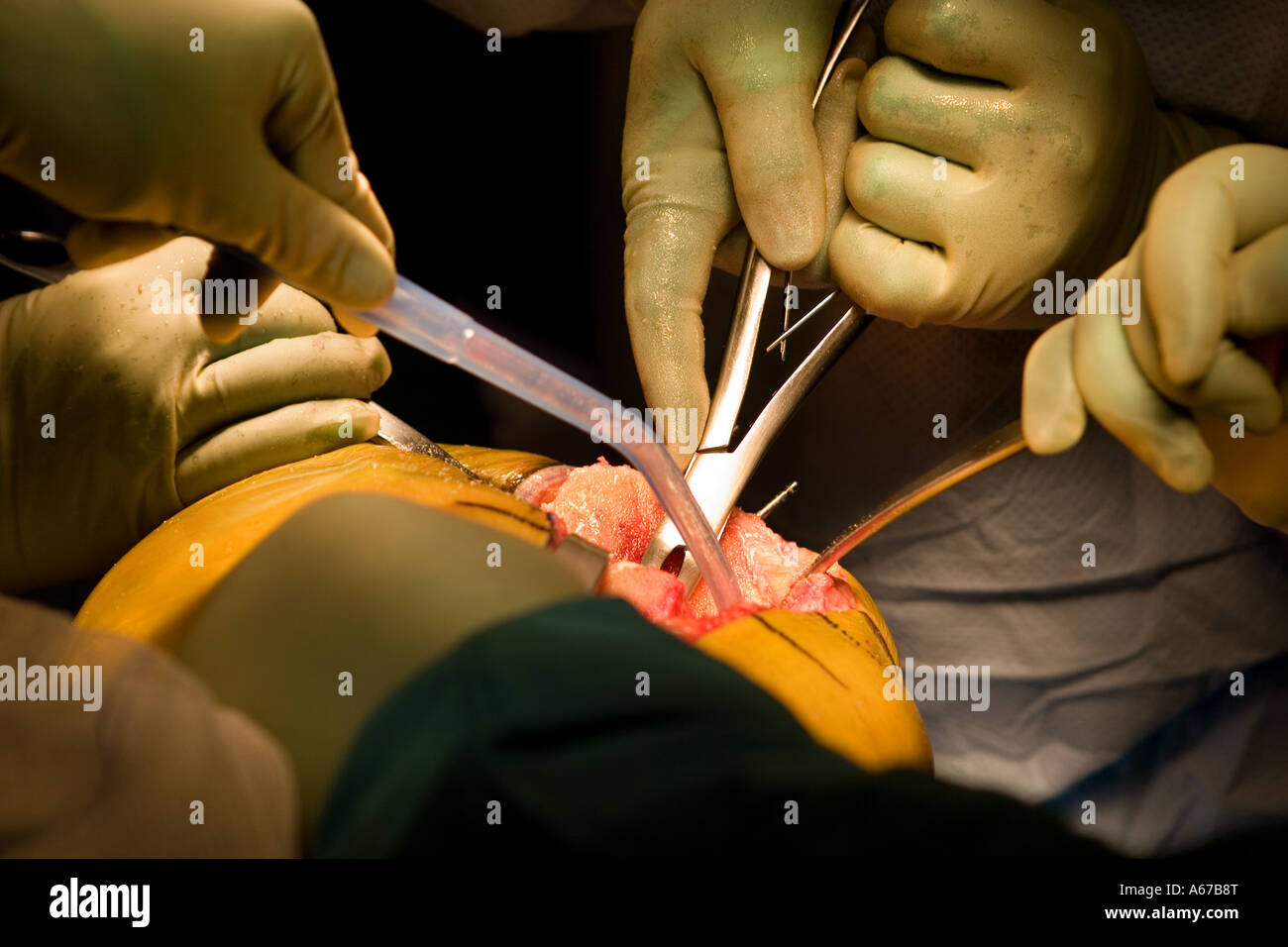 Chirurgien et les infirmières de la dépose d'un rongeur d'os sur un site d'incision du genou Banque D'Images