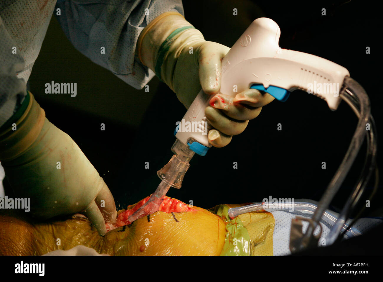 Nettoyage chirurgien en chirurgie du genou de la plaie avec une solution saline à l'aide d'un lavage d'impulsion et d'antibiotiques Banque D'Images