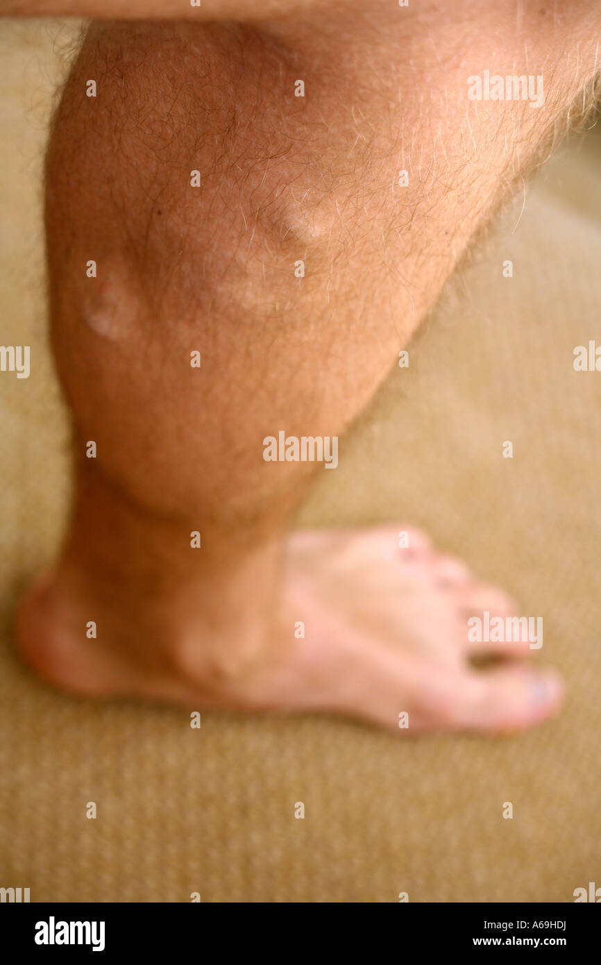 Varices sur les jambes du jeune homme Photo Stock - Alamy