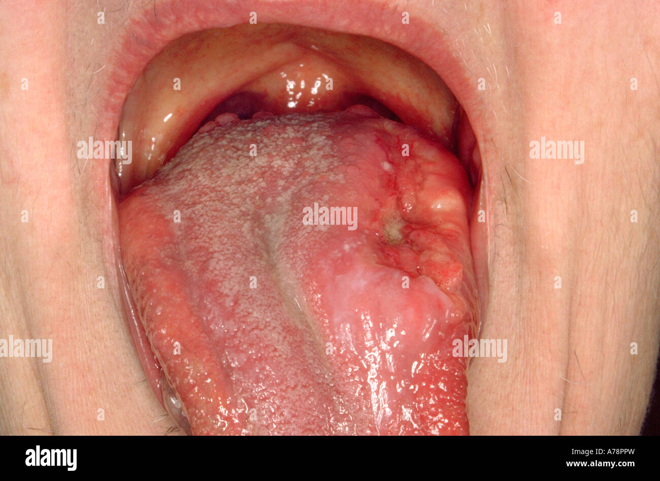 Comment Meurt On D'un Cancer De La Langue Cancer De La Langue Banque d'image et photos - Alamy