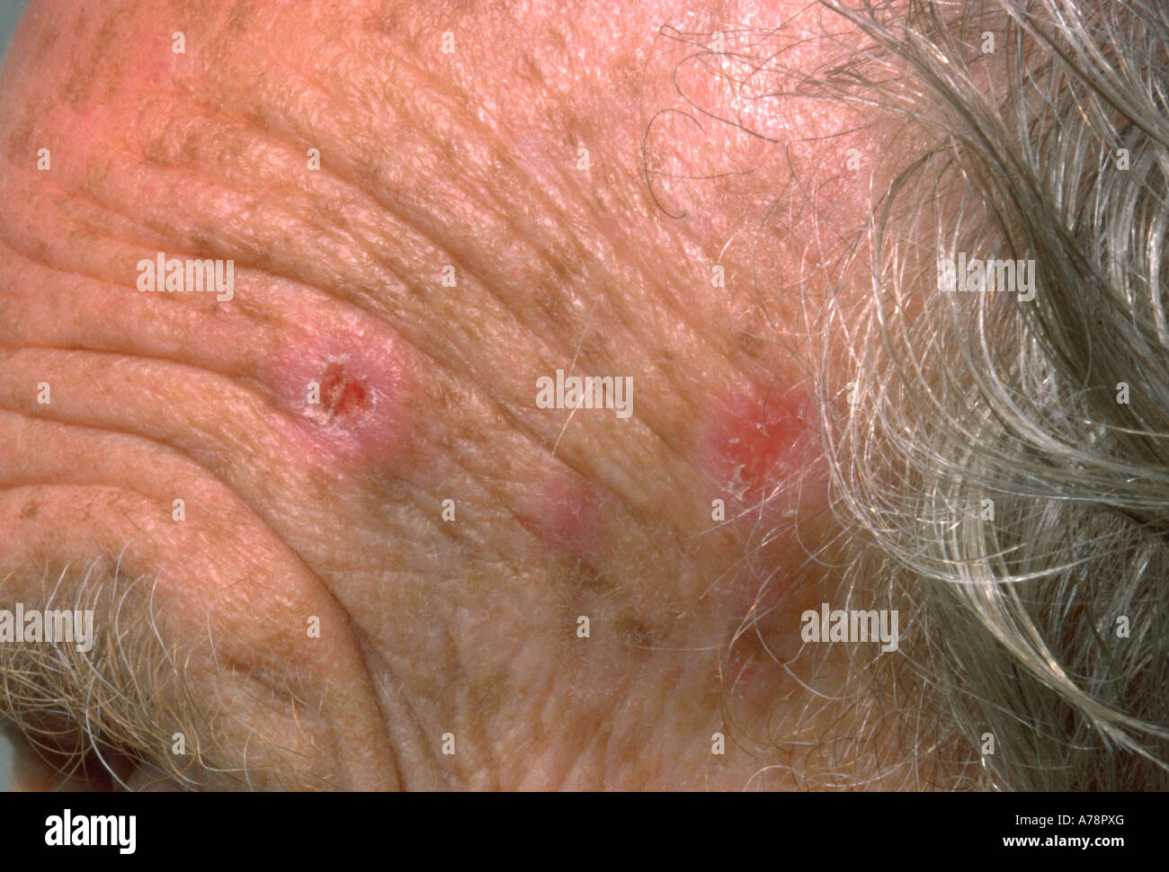 Keratose actinique Banque de photographies et d’images à haute
