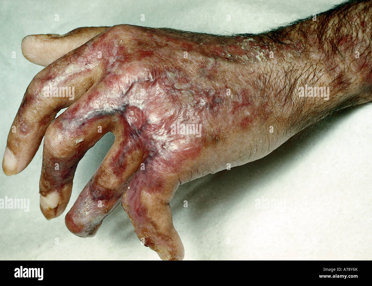 Brûlure chimique Banque de photographies et d’images à haute résolution Alamy