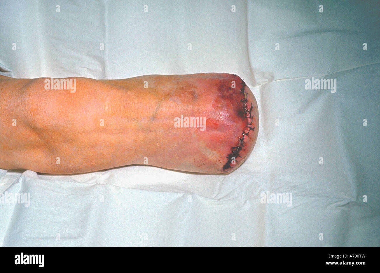 Une photographie d'un moignon d'amputation au-dessous du genou. Banque D'Images