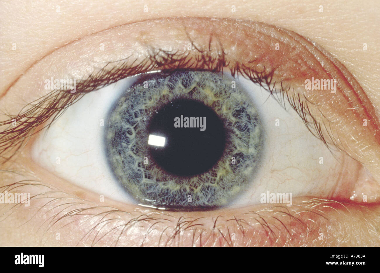 Pupille dilatée oeil normal Banque D'Images