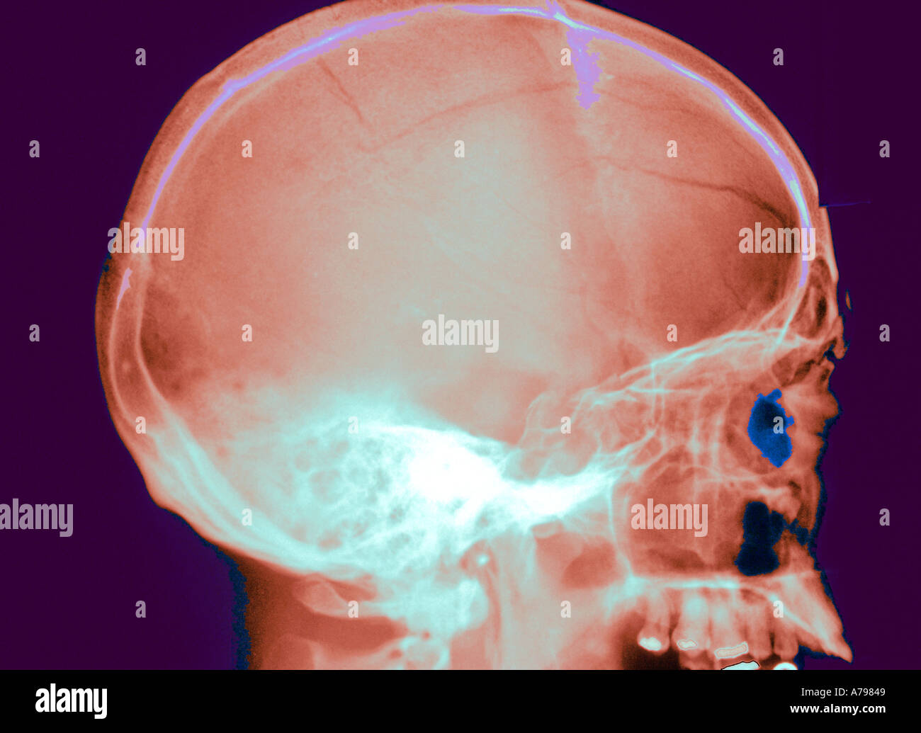 X ray crâne de couleur Banque D'Images