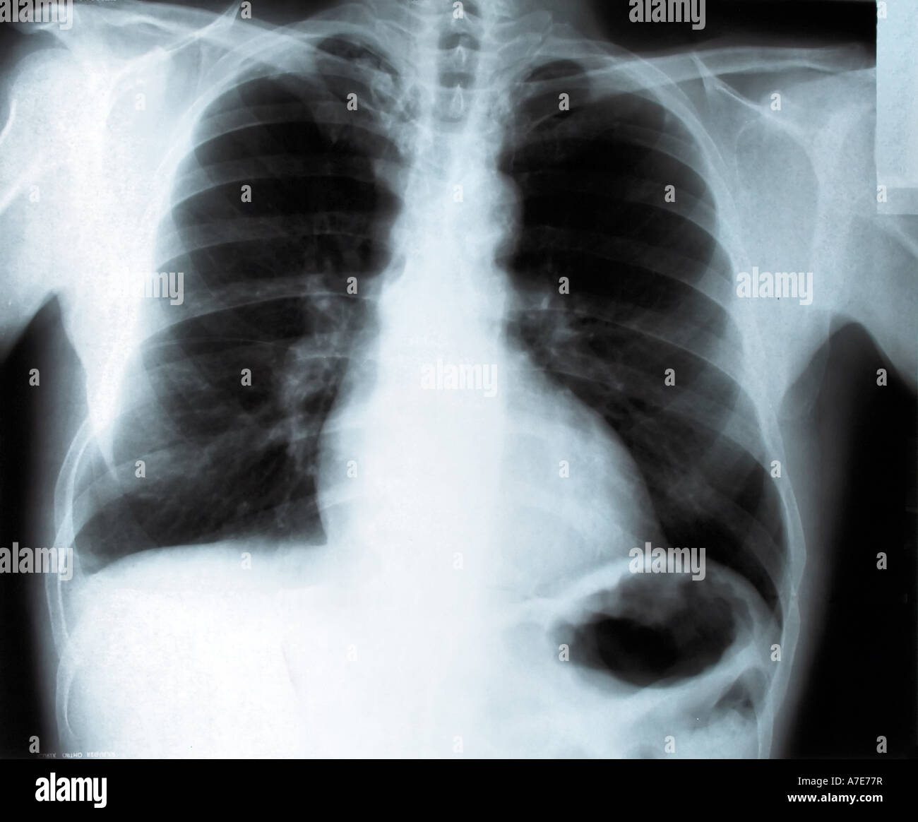 Radiographie des poumons d'un fumeur homme Photo Stock - Alamy