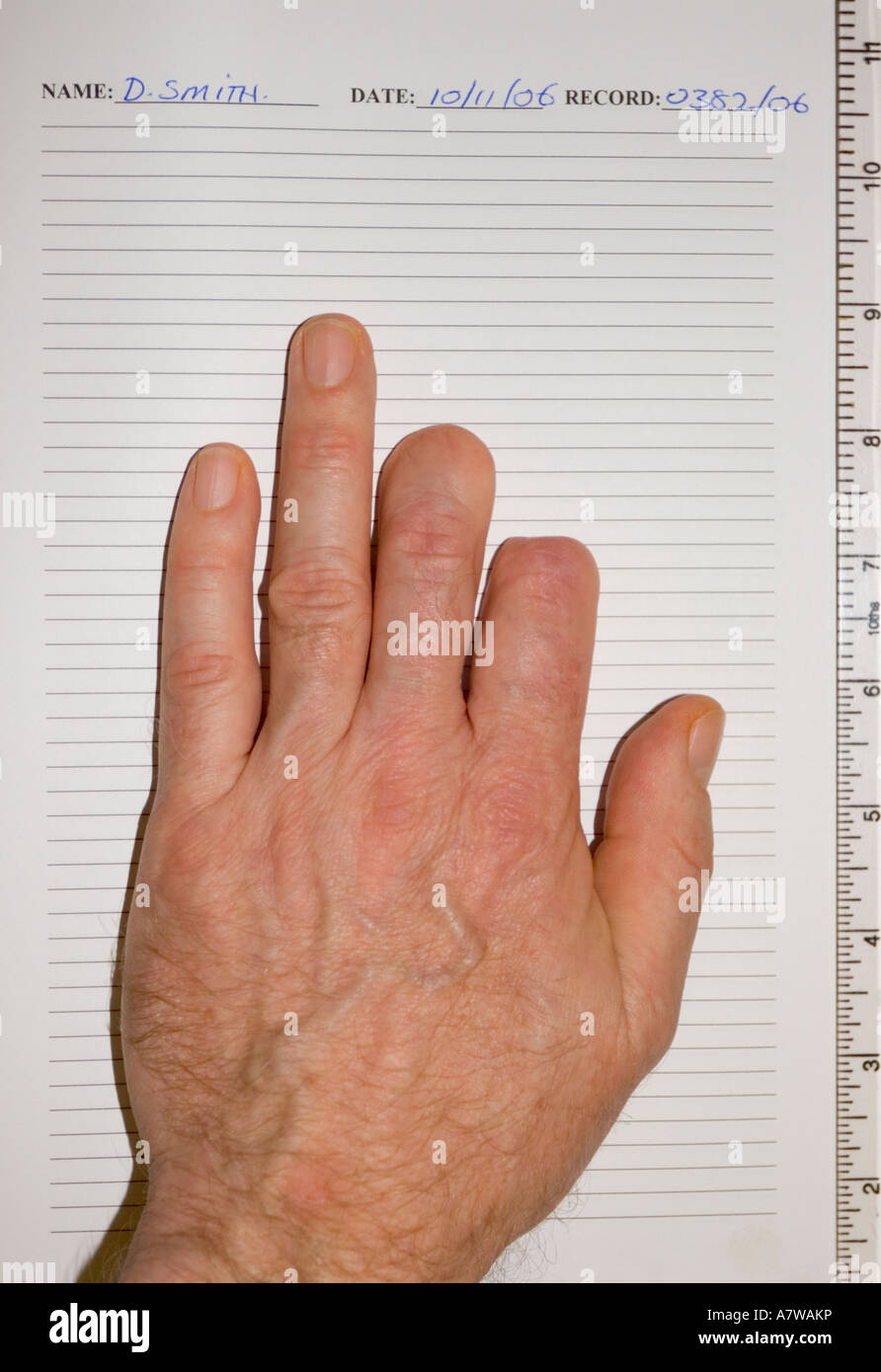 Un contre un tableau montrant les blessures dues à un doigt coupé par une  scie circulaire Photo Stock - Alamy