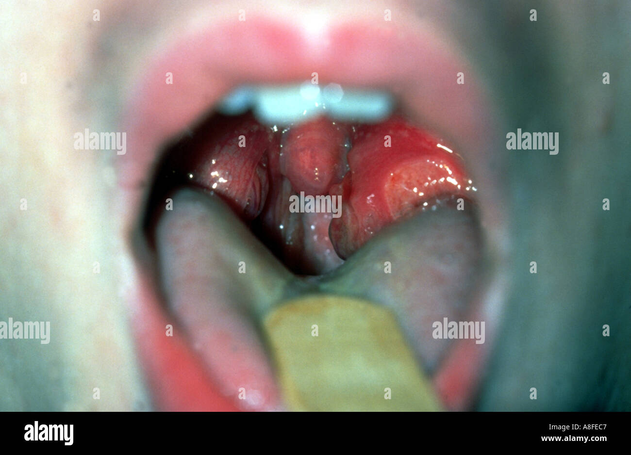 Abces Gorge Banque De Photographies Et D Images A Haute Resolution Alamy