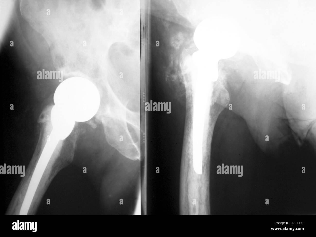 Suite hemiarthroplasty fracture col du fémur Banque D'Images